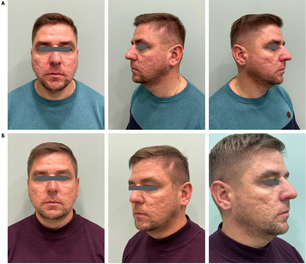 Пациент А., 35 лет: фото до коррекции и через 3 недели после процедур