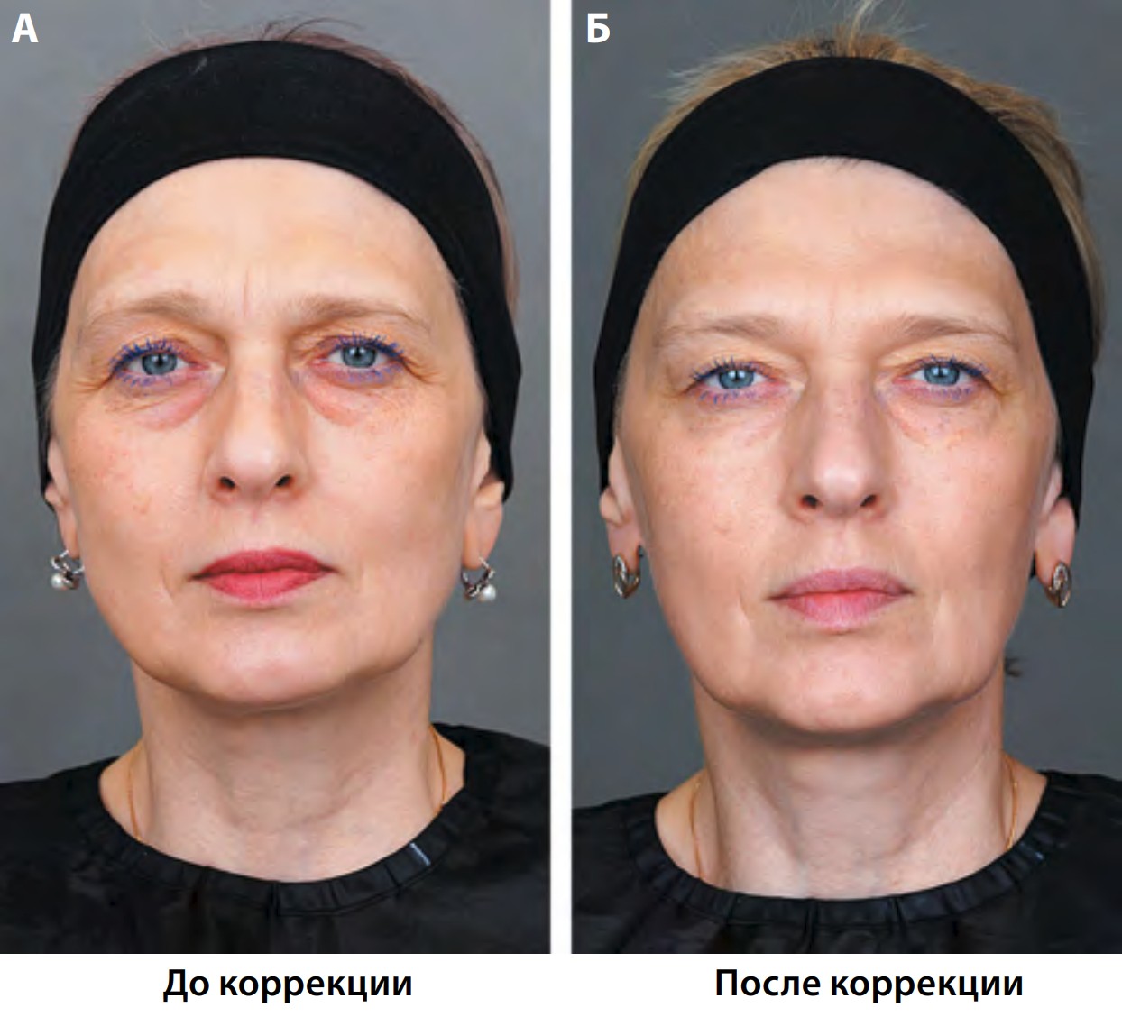 Рис. 1. Пациентка, 52 года