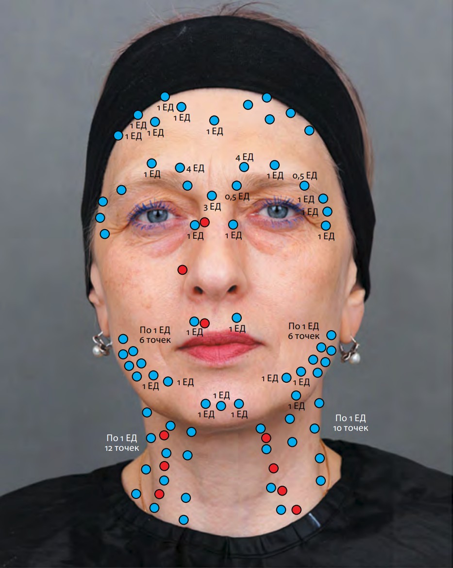 Рис. 2. Схема введения нейропротеина MIOTOX: синие точки — 1-й визит, красные точки — 2-й визит