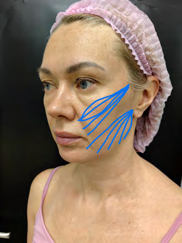 Схема введения нитей Excellence Visage в средней и нижней третях лица