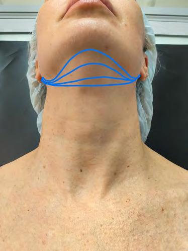 Схема введения Light Lift Needle Blunt в субментальной зоне